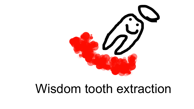 Wisdom tooth extraction 